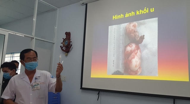 Các bác sĩ đã tiến hành phẫu thuật, lấy ra khối u như chiếc càng cua đã xâm lấn lên vùng sàn sọ.  