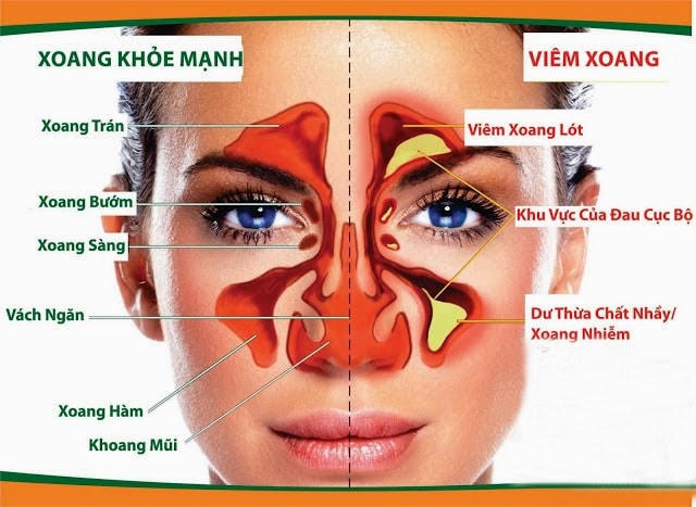 Bài thuốc đông y chữa bệnh viêm mũi mạn tính