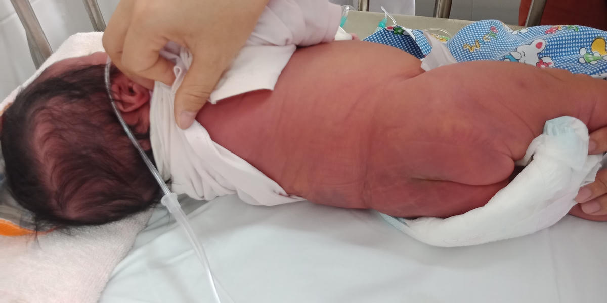 Bệnh nhi sơ sinh biến chứng nặng sau tắm nước lá cây chữa vàng da ở Cao Bằng.