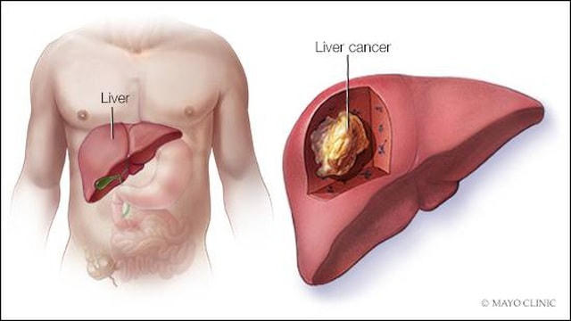 Đũa có dấu hiệu này cần vứt bỏ ngay để tránh rước ung thư vào người