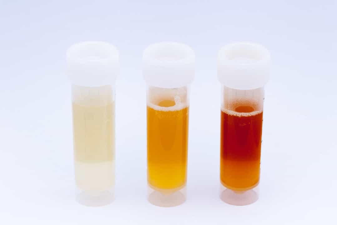 Nước tiểu của trẻ thực sự sẫm màu- Hãy đưa trẻ đến bác sĩ nếu con đi tiểu như nước ngọt. Ngoài ra, đây có thể là dấu hiệu cho thấy có máu trong nước tiểu.