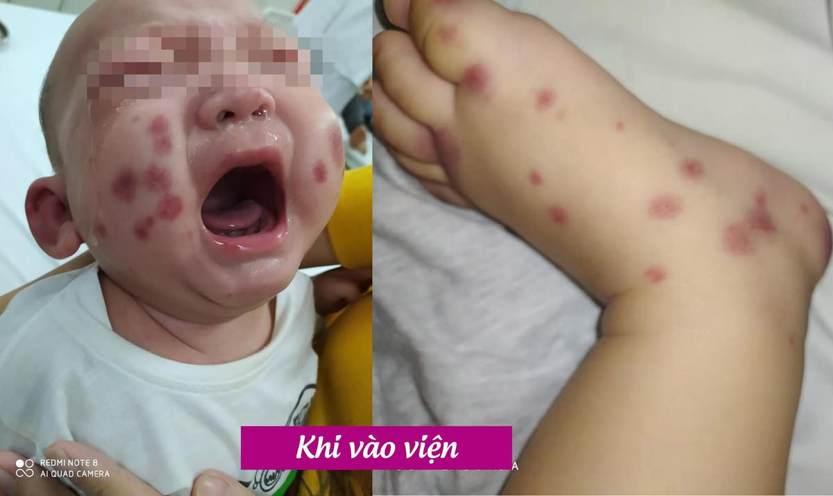 Tình trạng trẻ khi mới nhập viện