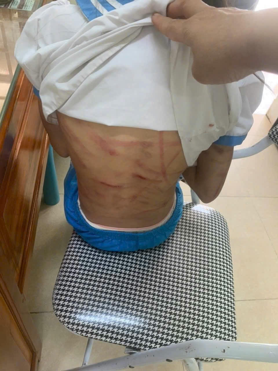 Vết bầm tím chi chít khắp cơ thể cháu H.T.N.L do bị bạo hành. Ảnh: NDCC