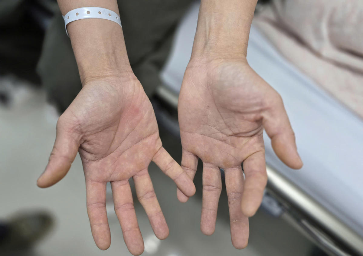 Bàn tay của bệnh nhân bị tê bì, không thể khép lại và mất cảm giác. Ảnh: BVCC