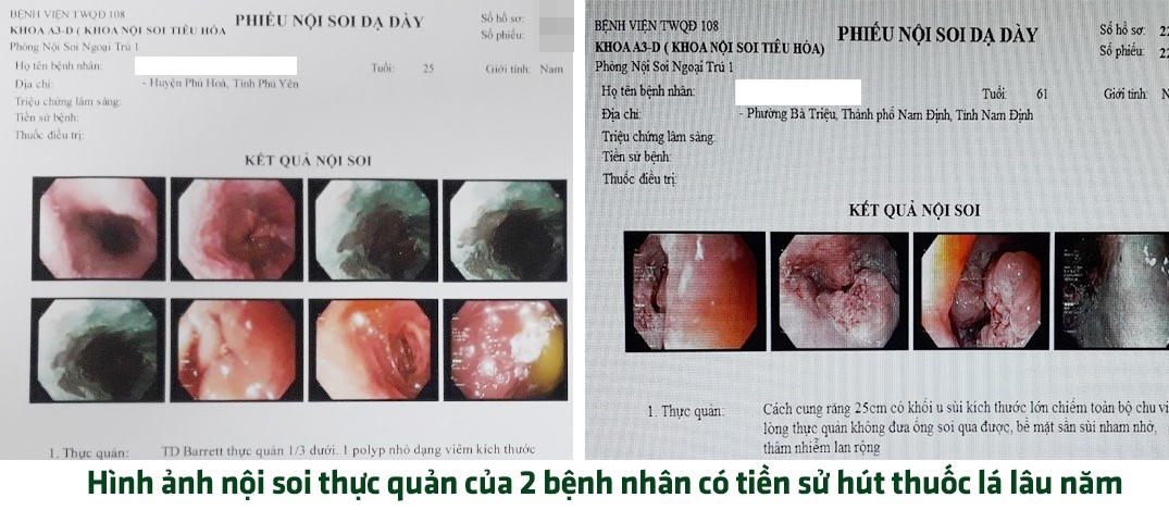 Thuốc lá – “thủ phạm” gây hại cho hệ tiêu hóa