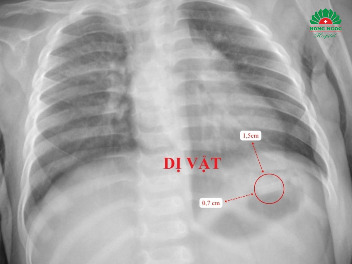 Vị trí dị vật trên phim chụp X-quang 