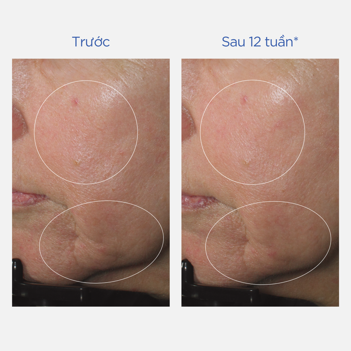 Hình ảnh lâm sàng sau 12 tuần sử dụng kết hợp Power C serum và Daily
Prevention.