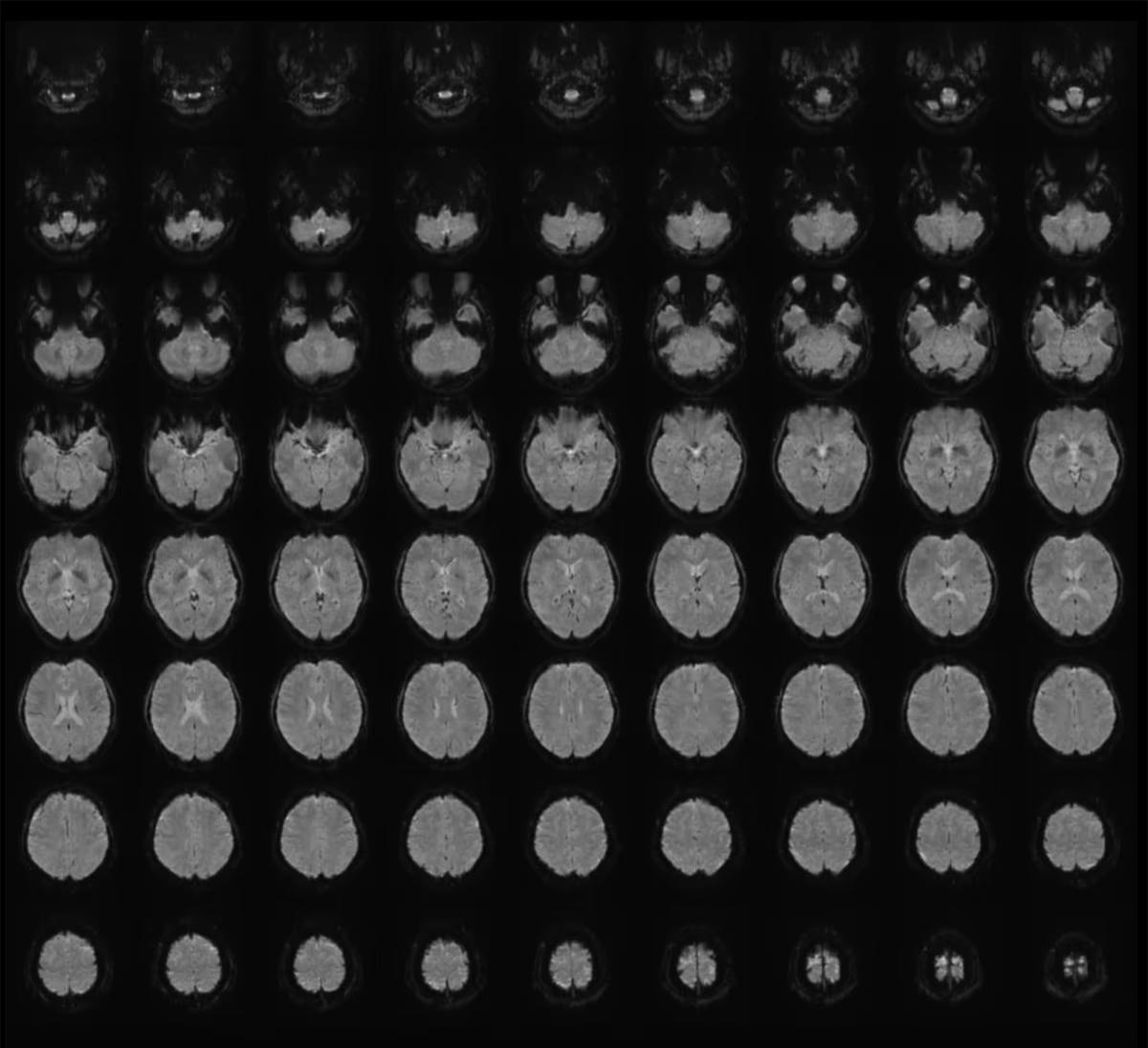 Ảnh chụp cộng hưởng từ chức năng cho thấy các lát cắt ngang của não.