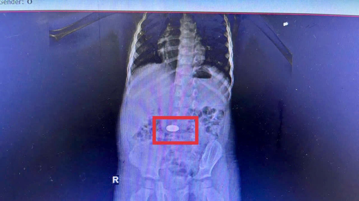 Kết quả chụp CT phát hiện dị vật nằm trong dạ dày của em bé 3 tuổi ở xã Khánh Vĩnh, tỉnh Khánh Hòa. Ảnh: BVCC
