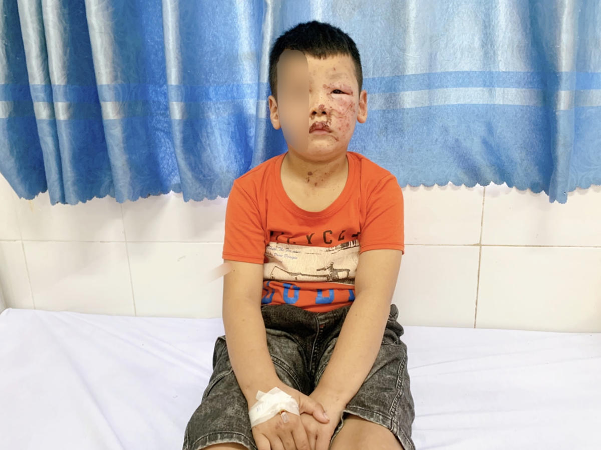 Nguyên nhân của phần lớn tai nạn bỏng ở trẻ xuất phát từ sự bất cẩn. Ảnh: BV Sản Nhi Bắc Ninh số 1