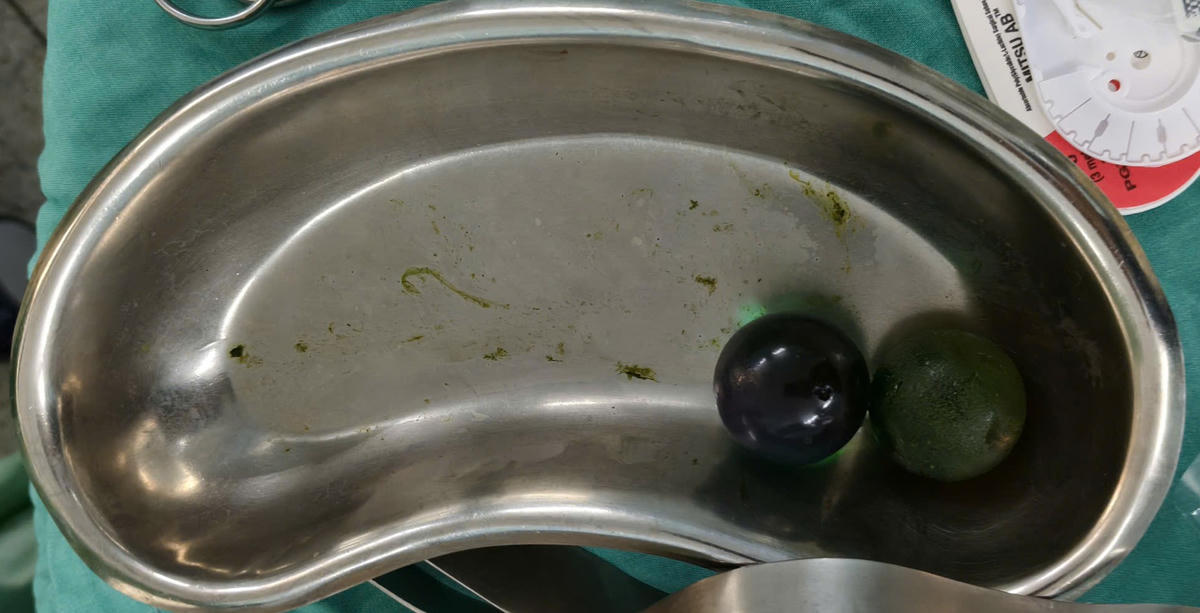Dị vật sau khi được bác sĩ lấy ra. Ảnh: S.X