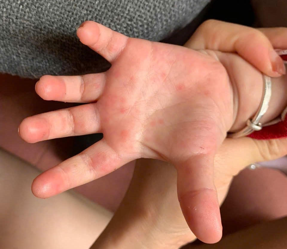 Trẻ bị tay chân miệng nổi ban ở lòng bàn tay. Ảnh: S.X