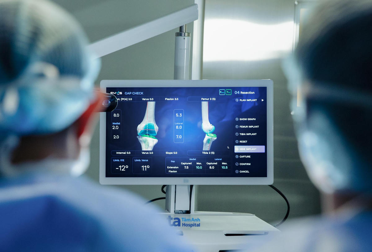 Phần mềm chuyên dụng của Robot CUVIS-Joint giúp bác sĩ kiểm tra và cân bằng tối ưu cấu trúc khớp, mô mềm và trục chi trong quá trình mổ. Ảnh: Bệnh viện Đa khoa Tâm Anh.
