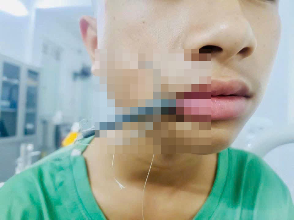 Nghệ An: Kịp thời cứu bé trai bị lưỡi câu cắm sâu vùng mặt