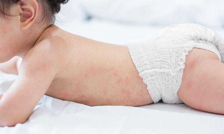 6 nguyên tắc giúp cha mẹ chăm sóc da trẻ khi bị rôm sảy trong mùa hè