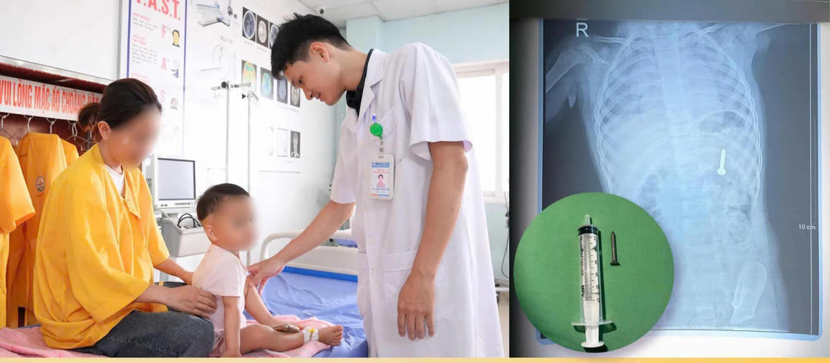 Kịp thời gắp dị vật sắc nhọn khỏi dạ dày trẻ nhỏ. Ảnh: BVĐKQT