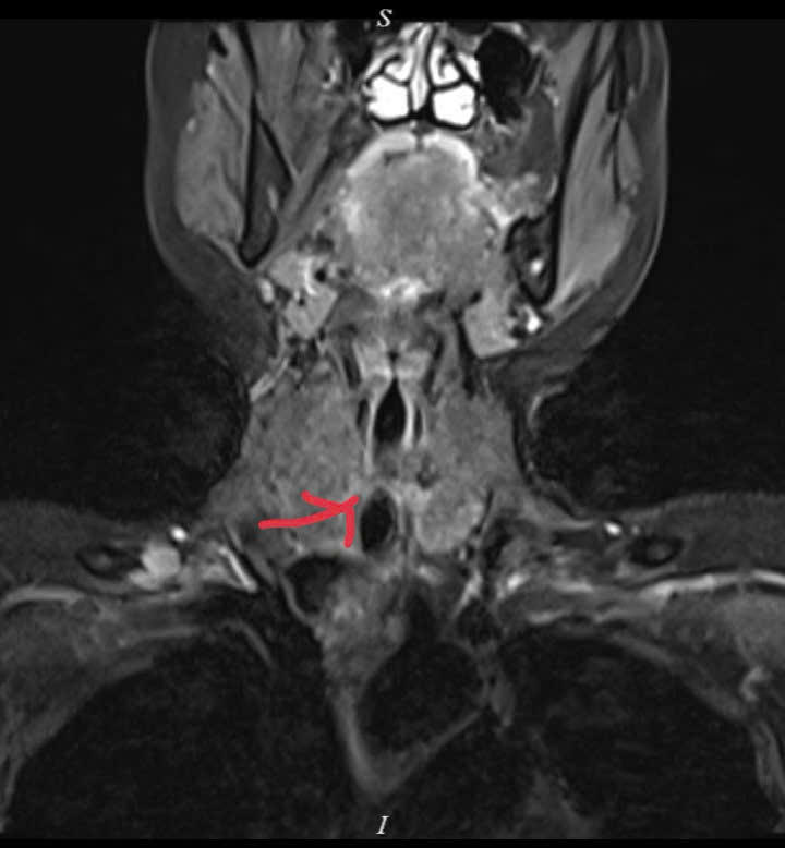 Hình ảnh MRI u khí quản trước phẫu thuật, khối u chèn ép gây hẹp khít đường thở. Ảnh: Bệnh viện C Đà Nẵng.