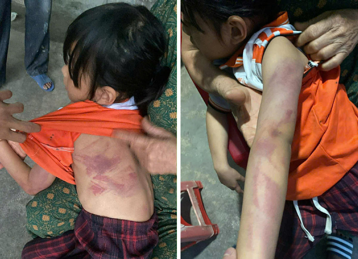 Những vết bầm tím trên người và tay của em T.T. Ảnh: NVCC
