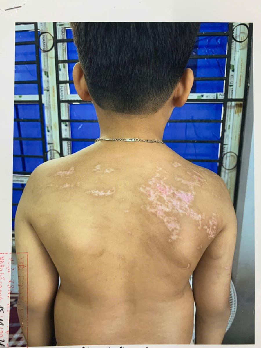 Trên người cháu N. Đ. B. K. bị thương tích sau khi bị Nguyễn Hà Chung (bố ruột). Ảnh: Công an tỉnh Phú Thọ.