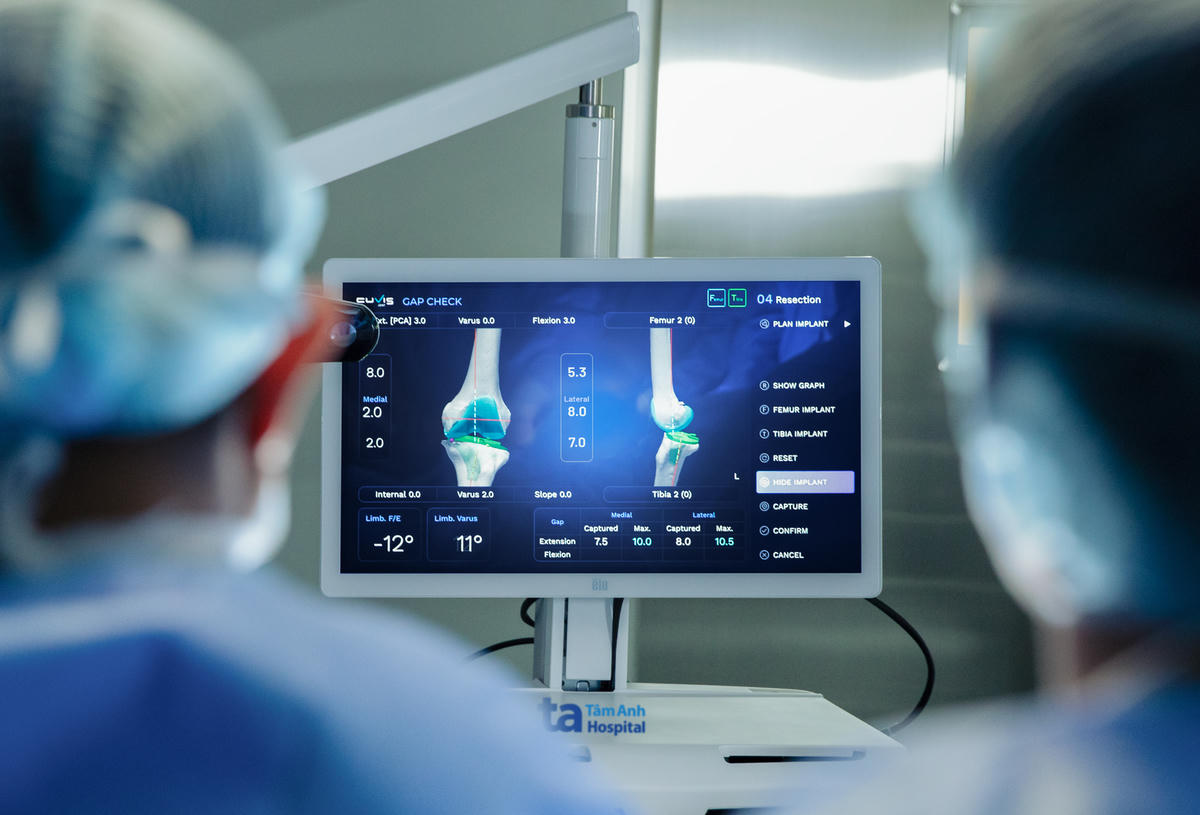 Robot CUVIS-Joint với phần mềm tích hợp AI giúp bác sĩ lập kế hoạch mổ “siêu nhanh” và dễ dàng tinh chỉnh kế hoạch trong lúc mổ, đảm bảo độ chuẩn xác vượt trội. Ảnh: Bệnh viện Đa khoa Tâm Anh