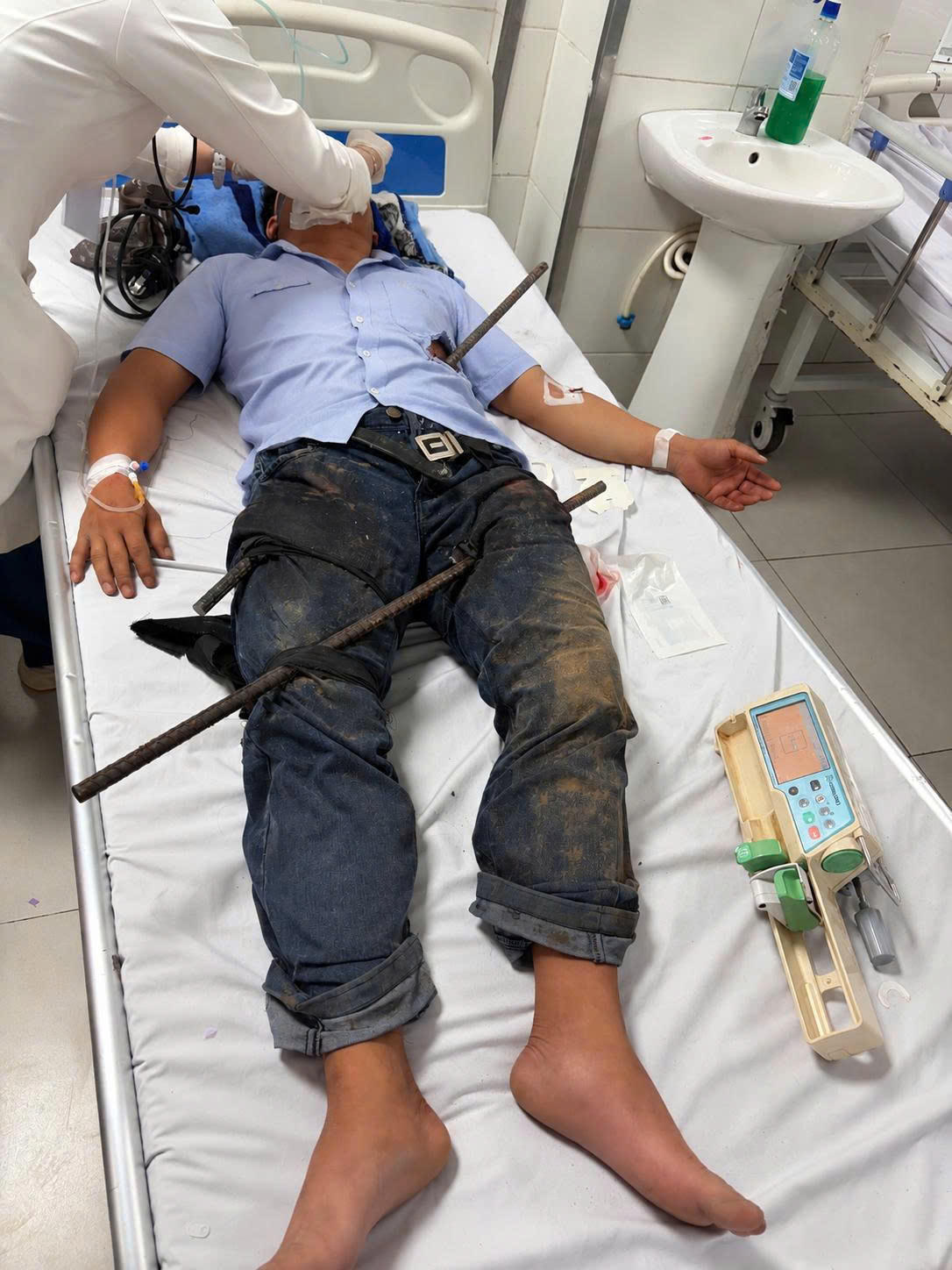 Bệnh nhân L.H.K. nhập viện trong tình trạng hai thanh sắt xuyên thấu người. Ảnh: T.Y