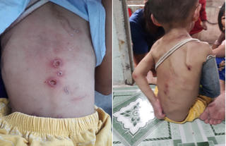 Điều tra vụ bé trai trên cơ thể có nhiều vết thương, nghi bị bạo hành