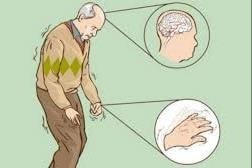Người mắc bệnh Parkinson cần tập phục hồi chức năng