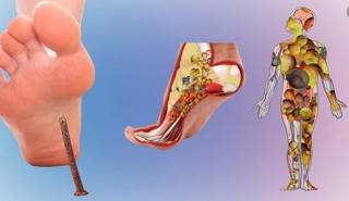 Không lơ là với nhiễm trùng uốn ván