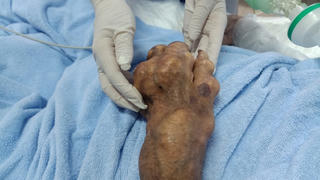 Bệnh gout: Gia tăng bệnh nhân trẻ tuổi