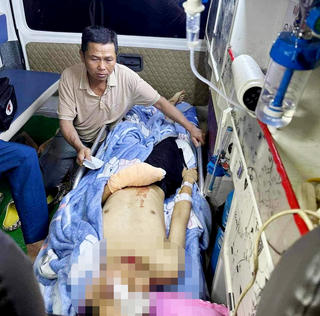 Sau tiếng nổ lớn, bàn tay nam sinh lớp 12 gần như bị đứt lìa