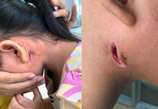 Bộ Y tế khuyến cáo cộng đồng phòng chống bệnh Whitmore