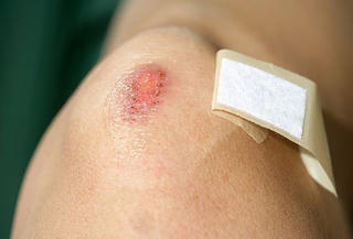 Hà Nội thêm ca mắc uốn ván: Chuyên gia khuyến cáo những trường hợp cần tiêm phòng