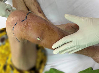 Cụ bà 72 tuổi nhiễm trùng huyết từ vết xước nhỏ ở cẳng chân