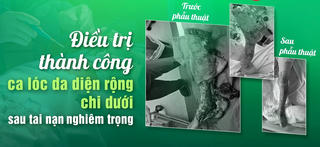 Điều trị thành công ca lóc da diện rộng