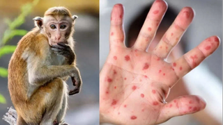 Chủ động ứng phó với bệnh đậu mùa khỉ