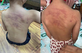 Hải Phòng: Cảnh cáo 3 giáo viên để xảy ra việc cháu bé 5 tuổi bị bầm tím vùng lưng