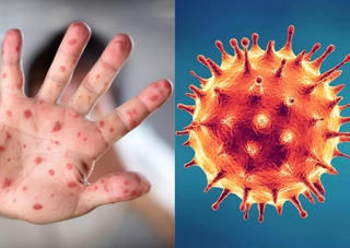 Cẩn trọng với bệnh đậu mùa khỉ