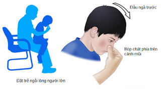 Làm gì khi trẻ bị chảy máu cam?