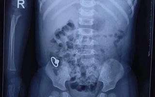 Đề phòng nguy cơ trẻ nuốt dị vật