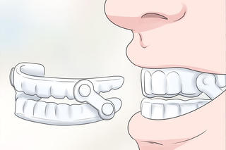 Nghiến răng là một bệnh lý