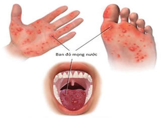 3 dấu hiệu cảnh báo bệnh tay chân miệng trở nặng