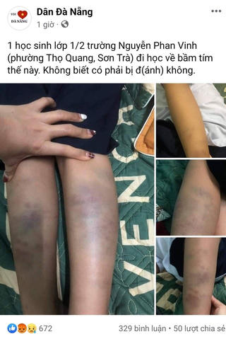 Đà Nẵng: Không khởi tố hình sự vụ 'trẻ lớp 1 bị bầm tím tay chân khi ở trường về'