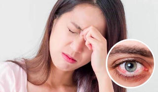 Dịch đau mắt đỏ diễn biến 'căng thẳng': Bác sĩ khuyến cáo 6 'Không'