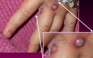 Bộ Y tế yêu cầu giám sát, phát hiện ca nghi ngờ mắc 'bệnh đậu mùa khỉ' tại cửa khẩu