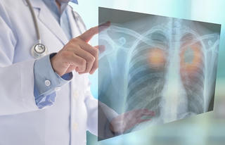Hướng tới xây dựng chương trình sàng lọc ung thư phổi toàn diện