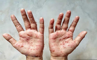 Bệnh viện đầu ngành truyền nhiễm chuẩn bị ứng phó với đậu mùa khỉ