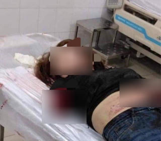 Nghi vợ ngoại tình, chồng chém lìa 2 cánh tay vợ