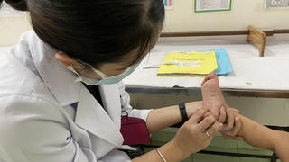 Bệnh tay chân miệng diễn biến phức tạp