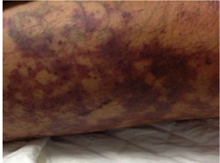 Thanh niên suy đa phủ tạng sau khi giết mổ lợn, bác sĩ chỉ nguyên nhân