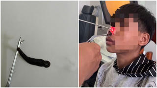 Quảng Trị: Gắp thành công con đỉa lớn ra khỏi mũi của nam bệnh nhân